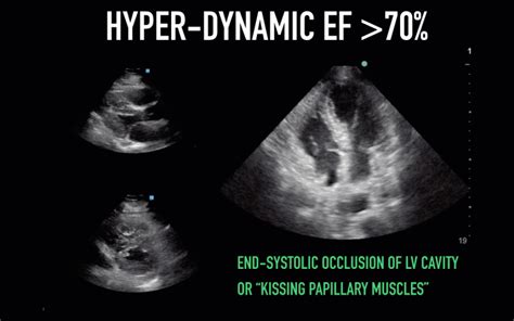 lv sf|echocardiography lv function.